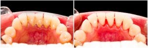 deep cleaning teeth before and after
