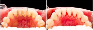deep cleaning teeth before and after