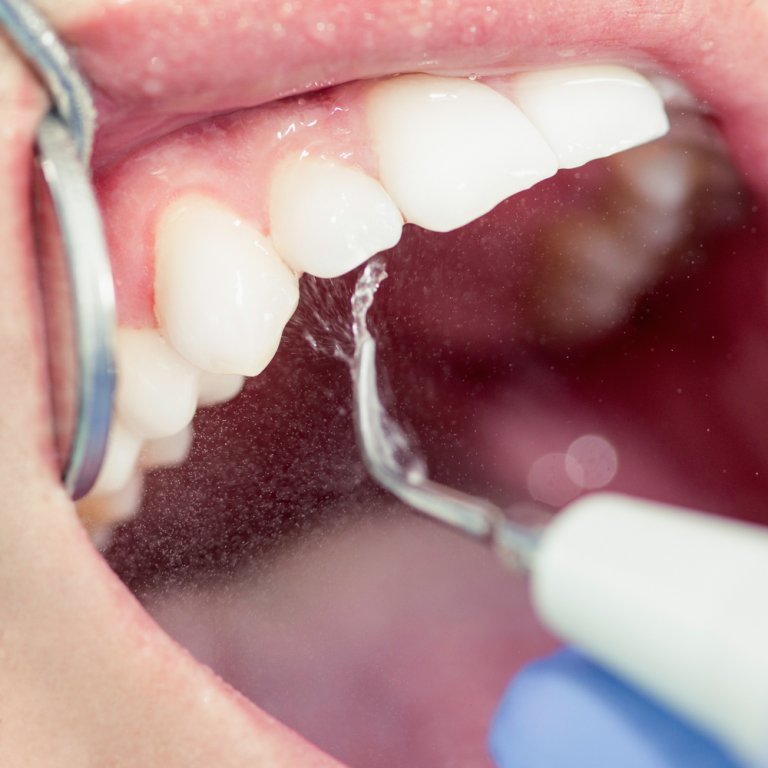 Remove Tartar from Teeth Scale & Polish Dental Cleaning