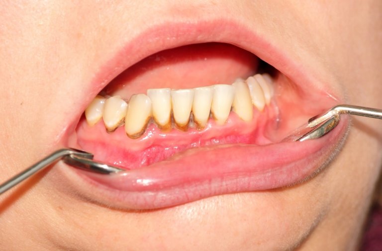 What is Plaque vs Tartar & How to Remove Plaque from Teeth
