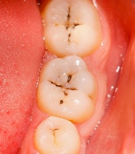 dental fissures with decay