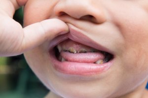 child with tooth decay