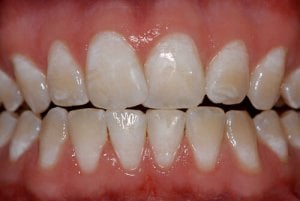 moderate mild dental fluorosis picture