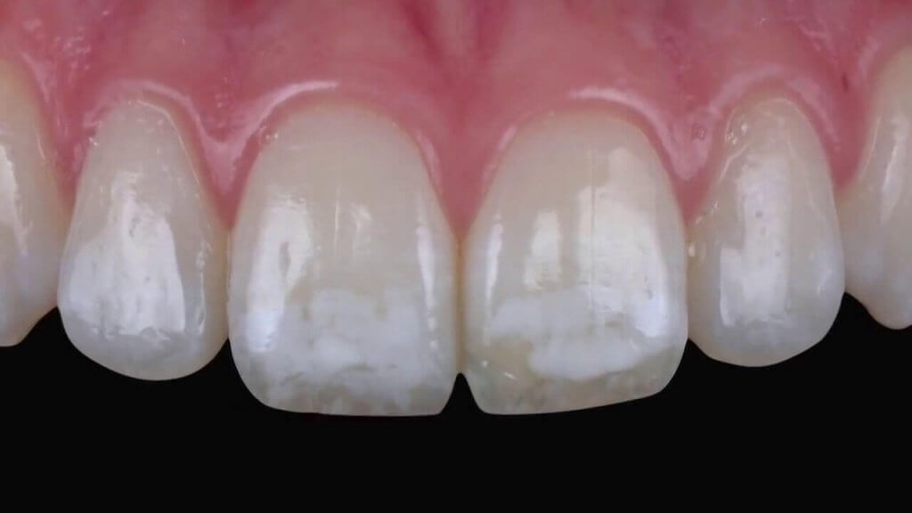 Dental Fluorosis Too Much Fluoride, White Spots on Teeth
