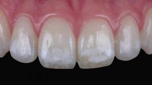 white spots on teeth child nhs