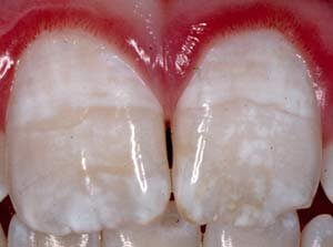 fluorosis treatment uk