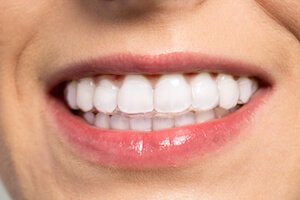 clear aligners uk