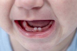 gap between first baby teeth