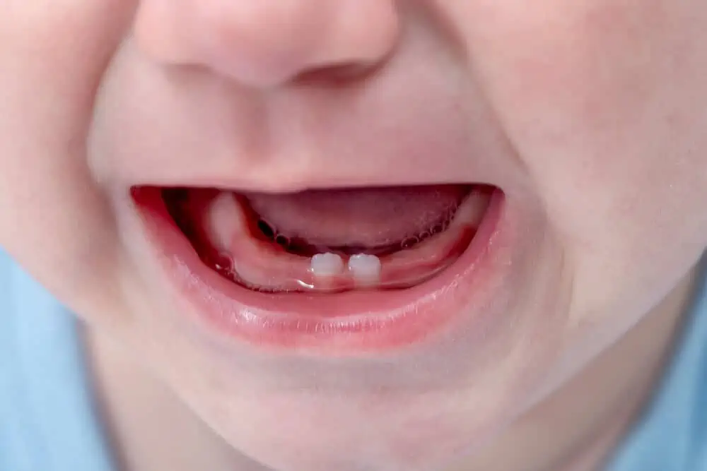 Baby Teeth Guide: What to Expect, Milk Teeth Care & Problems