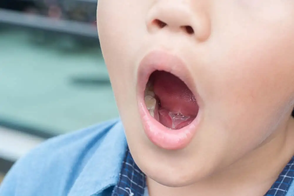 Tongue Tie in Babies and Adults Treatment, Problems Feeding