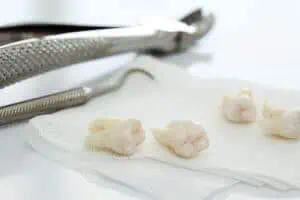 wisdom teeth extraction recovery