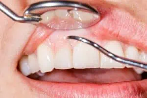 how to stop receding gums