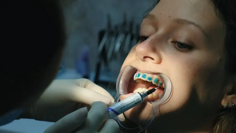 dental adhesive for braces