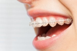 Radiance braces before and after 
