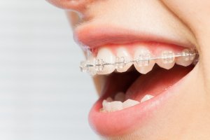 white braces