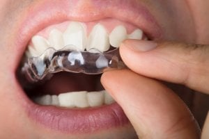 teeth clear aligners
