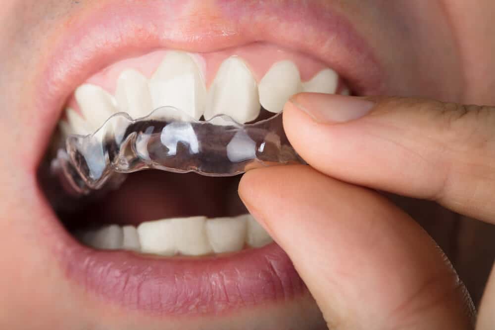 Your Smile Direct Review for the UK Do Clear Aligners Work?