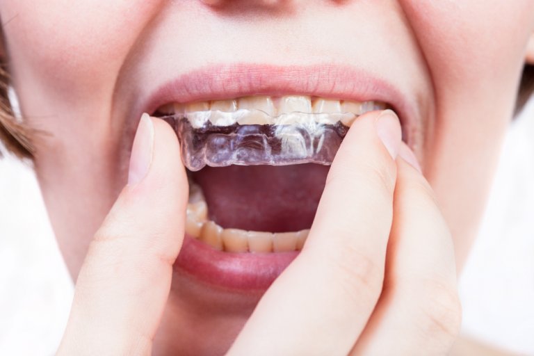 Invisalign Alternatives and Competitors Best and Cheapest in the UK