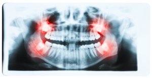 wisdom teeth dry socket