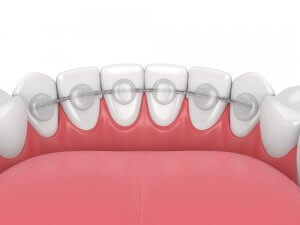 bonded vs hawley wire retainer