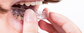 Removable retainers are easy to use