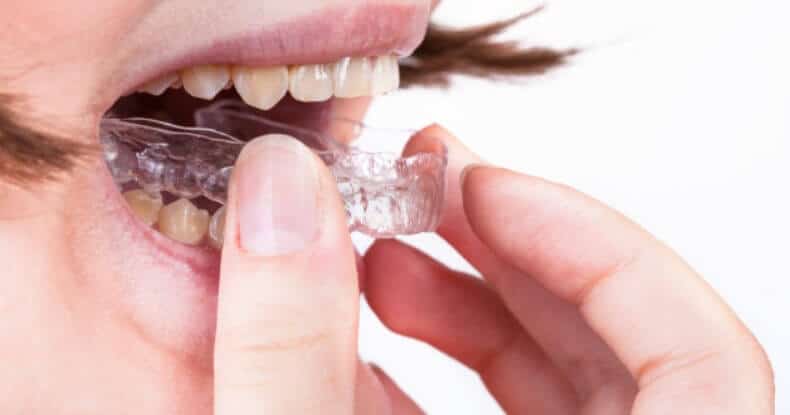 Removable retainers are easy to use
