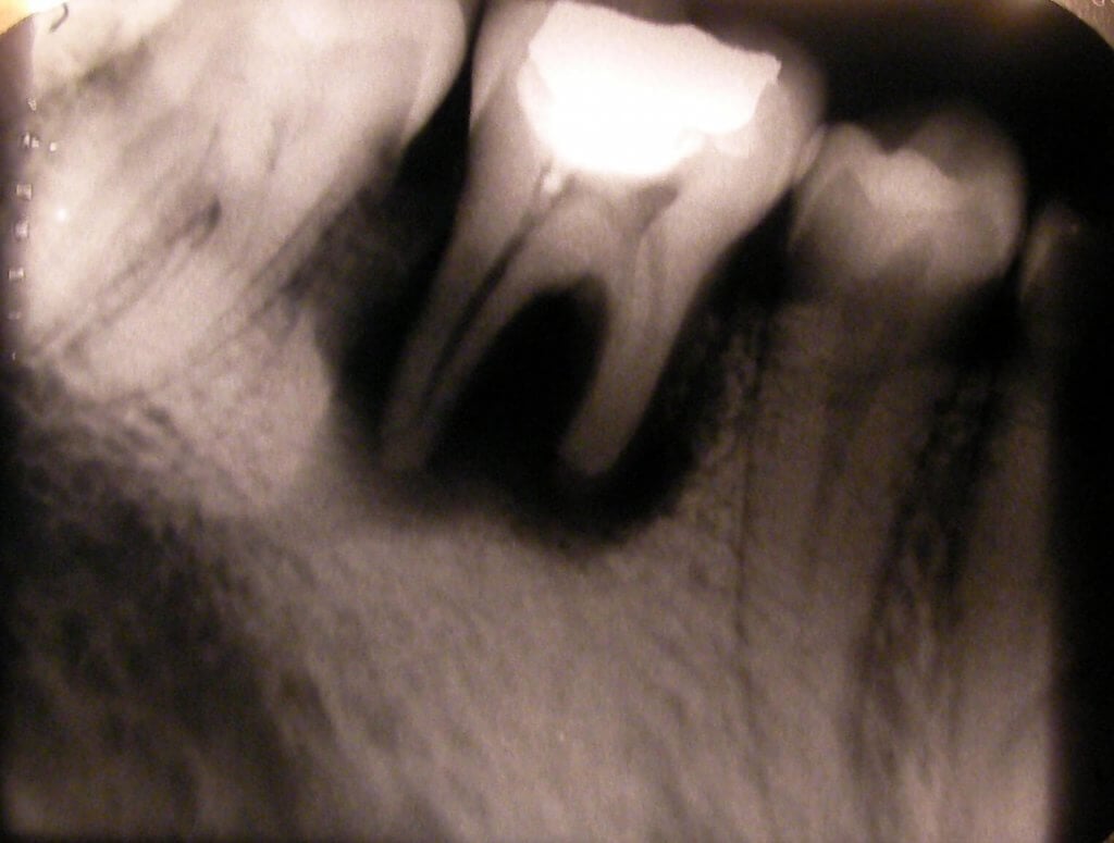 X-ray showing tooth resorption