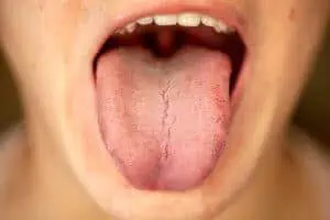 oral thrush on tongue symptoms