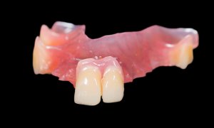 acrylic partial denture front teeth