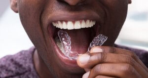 cost of lingual braces vs invisalign