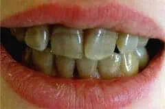 Tetracycline Teeth stains