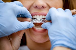 dentist fitting clear aligners in a patient's mouth