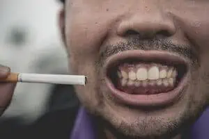 smoking and teeth