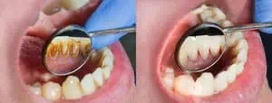 smokers teeth after removing stains