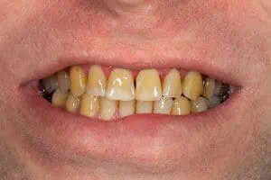 Yellow stained teeth from smoking
