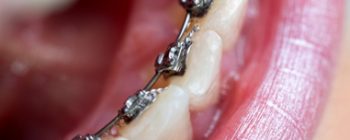 lingual braces uk