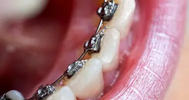 lingual braces uk