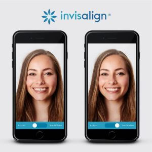 invisalign comprehensive package