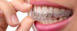 inman aligner or invisalign