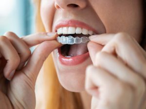 woman with removable aligner braces