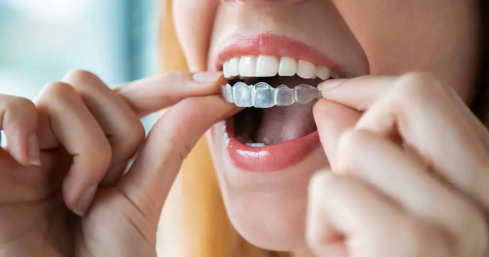 removable braces uk