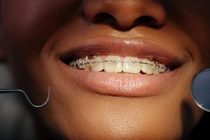 clear braces cost uk