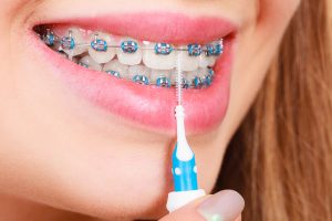 how to clean braces on teeth