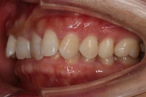 crowded teeth being treated with invisalign