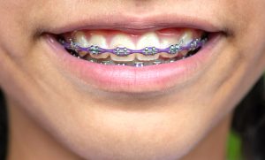 purple braces with power chain