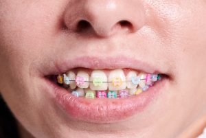 fake braces for kids