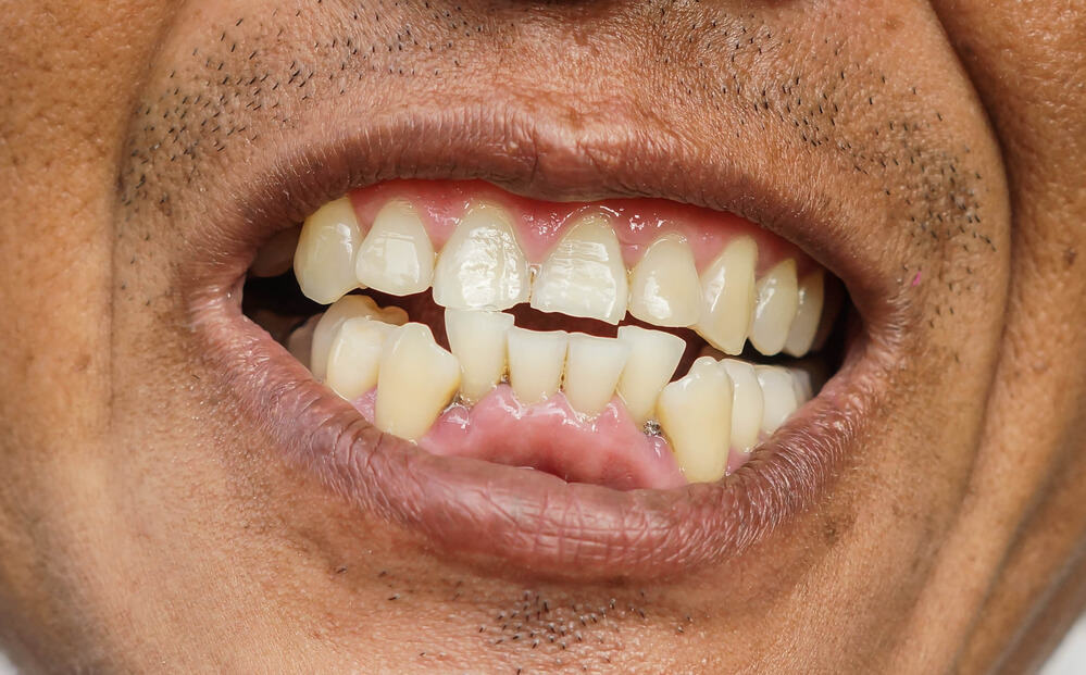 How Long Do Braces Take? Types of Braces, Age and Complex Cases