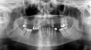 tooth implants nhs criteria