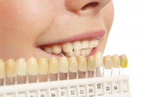 dentists teeth whitening costs