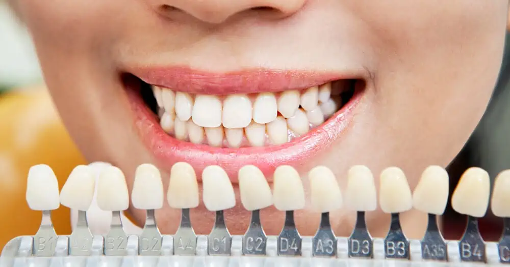 teeth whitening cost uk